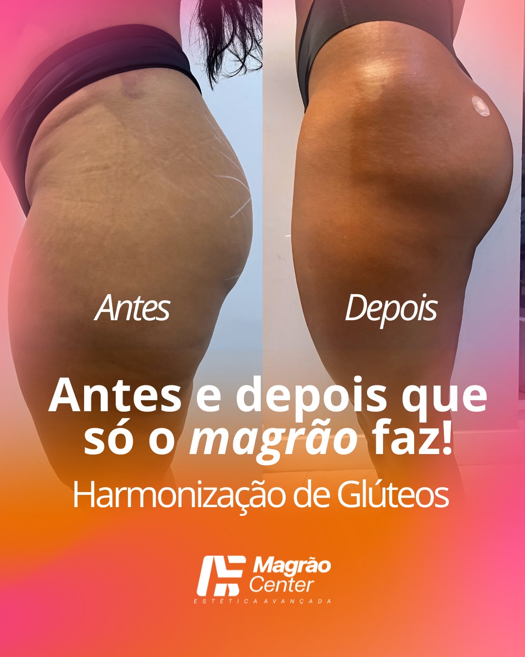 Resultado Glúteos 1 – Antes e Depois