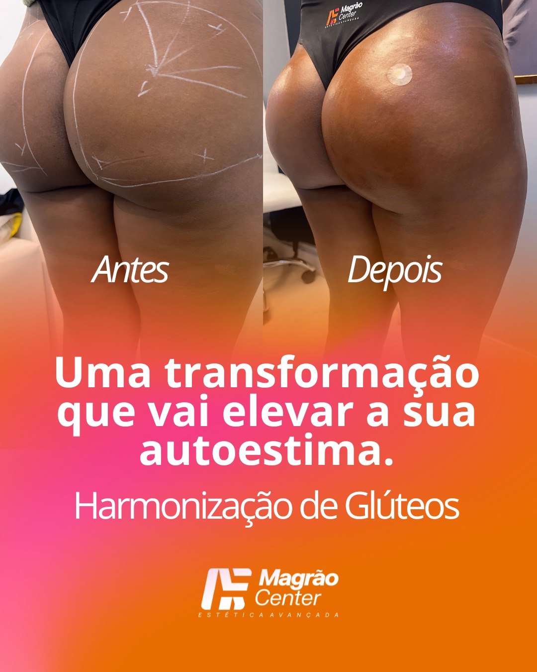 Resultado Glúteos 2 – Antes e Depois