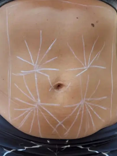 Antes do tratamento de firmeza abdominal