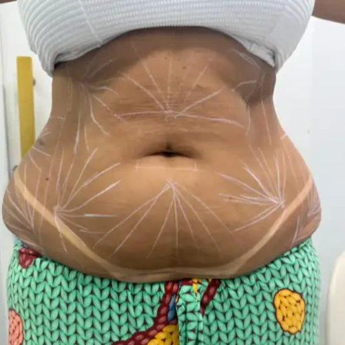 Antes de Endolaser abdomen total