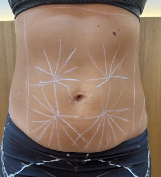 Antes do tratamento de firmeza abdominal