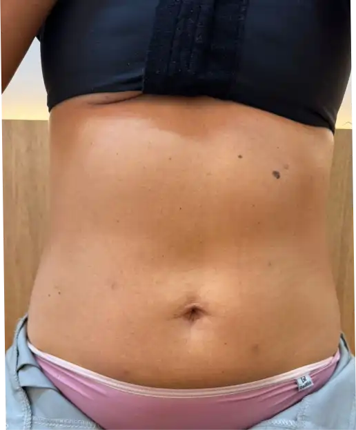 Depois do tratamento de firmeza abdominal